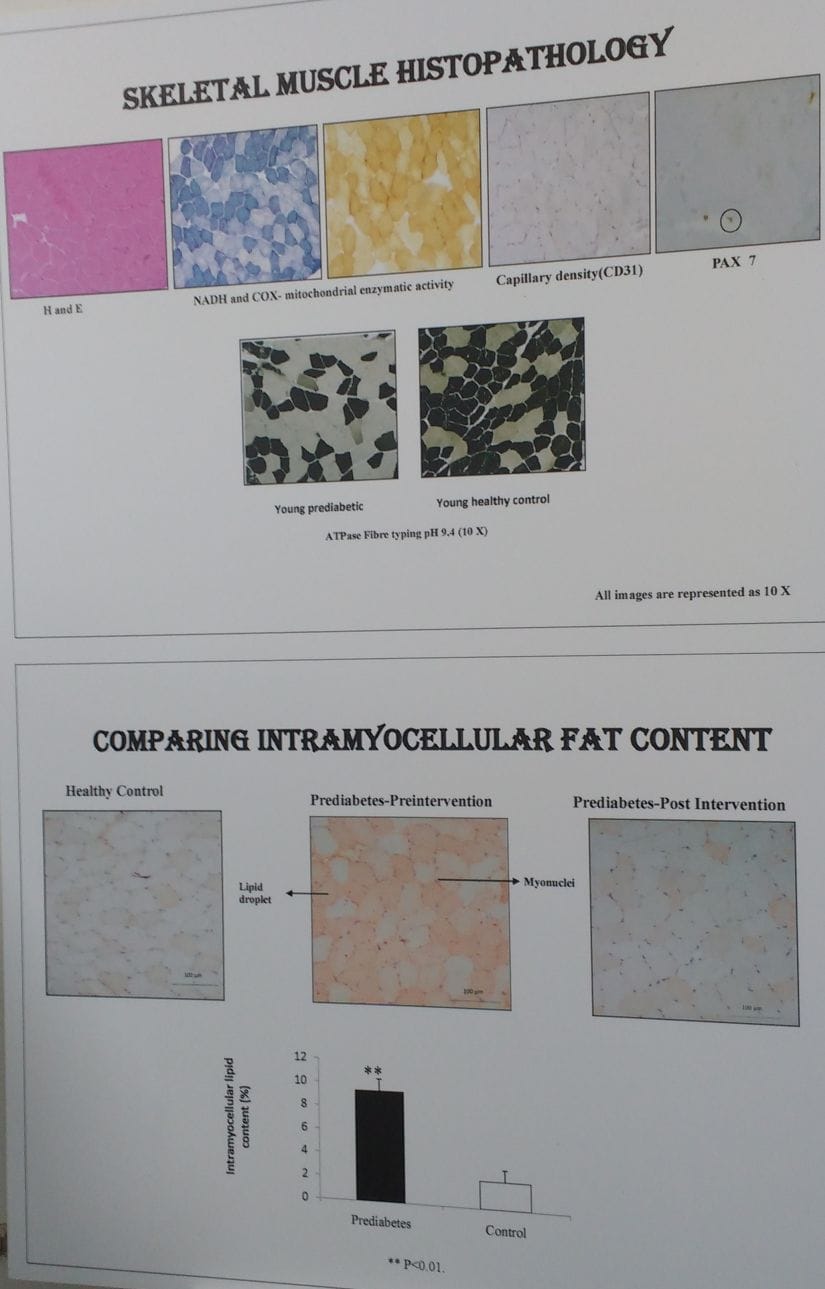 Tissue showing healthy individual vs pre-diabetes and after the intervention, in pre-diabetes, the reduction in fat cells, stained in orange