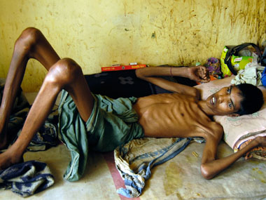 Battle against drug-resistant TB: Like South Africa, India needs to allow access to 'game-changing' bedaquiline, says researcher Battle against drug-resistant TB: Like South Africa, India needs to allow access to 'game-changing' bedaquiline, says researcher