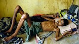 TB-free India by 2025 an aspirational goal, but paying attention to nutrition key to beating disease