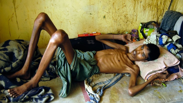 Indo-US trade war is a new challenge to India’s TB elimination program