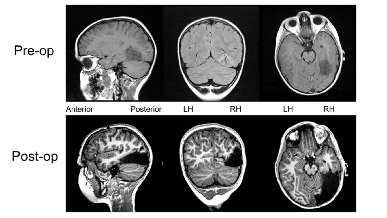   MRI scans of UD's brain before and after surgery. Changed from the publication in Cell Reports. 