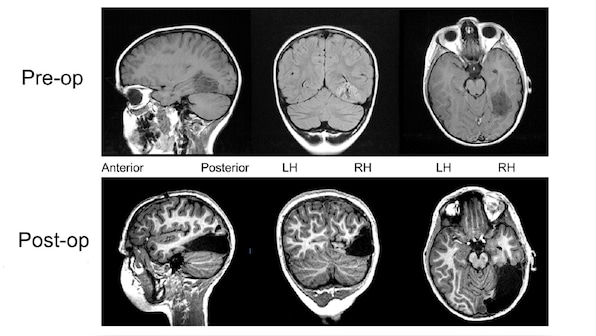 Despite big chunk of his brain being removed, boy's recovery is dramatic