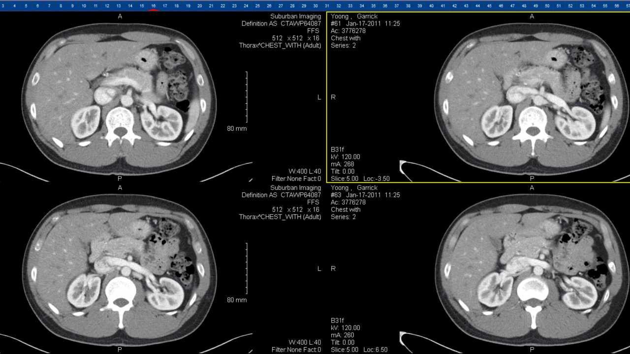 This image shows 4 slices of a chest CT scan. Flickr