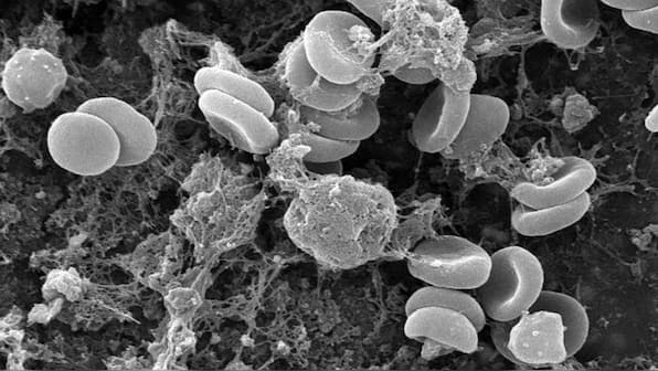 Cutting down on rock salt and fluoride can help tackle anaemia, a new study finds