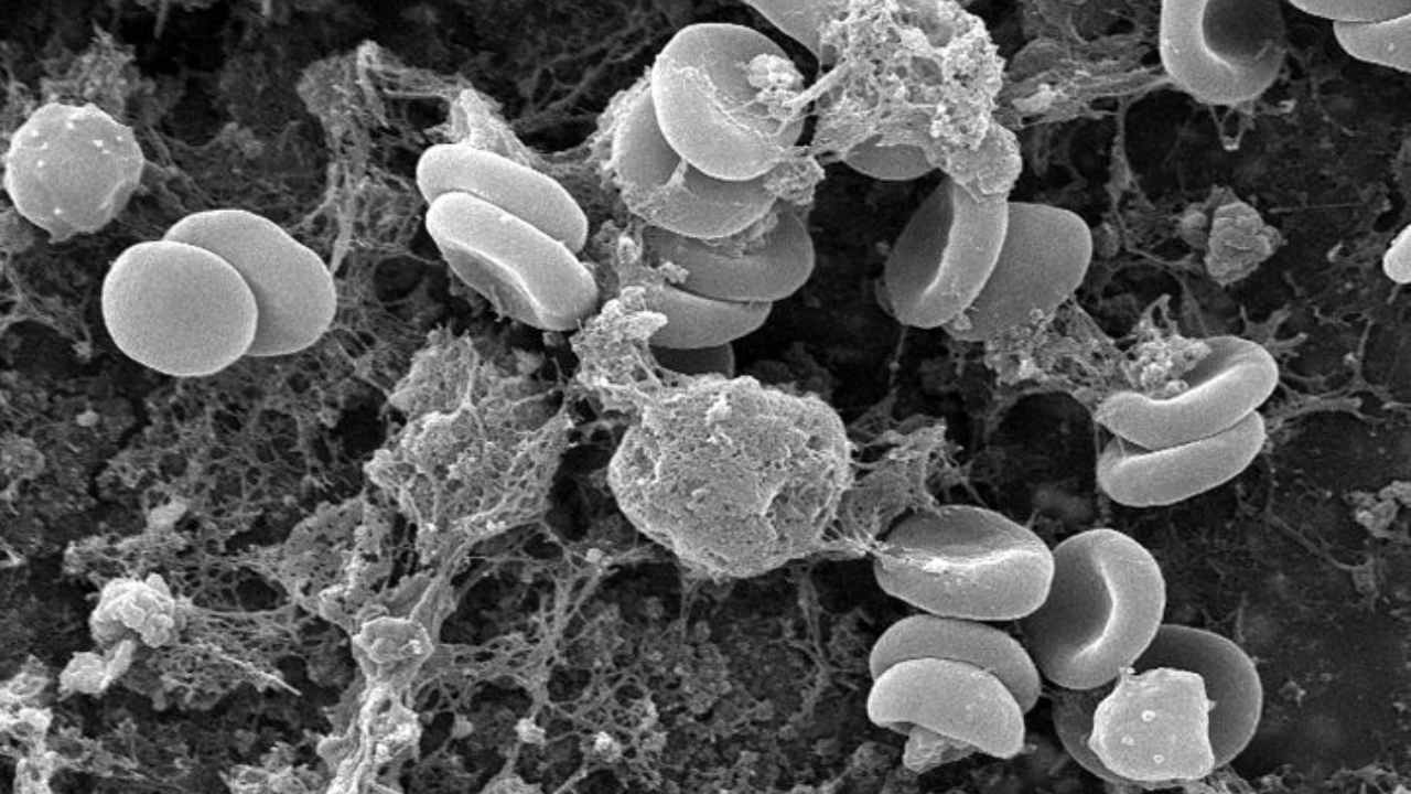 Cutting down on rock salt and fluoride can help tackle anaemia, a new study finds Cutting down on rock salt and fluoride can help tackle anaemia, a new study finds