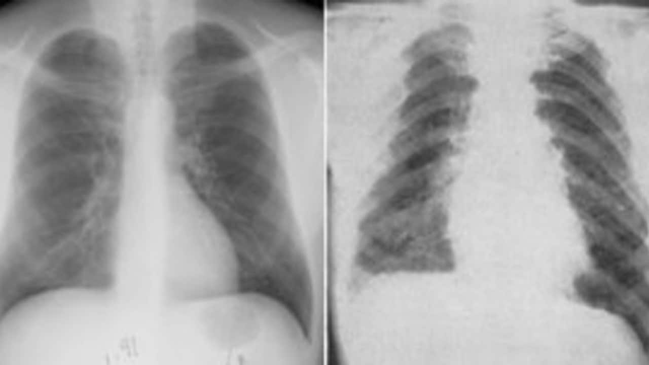Radiology reports showing lung damage from heavy metal poisoning. Image courtesy: University of Virginia