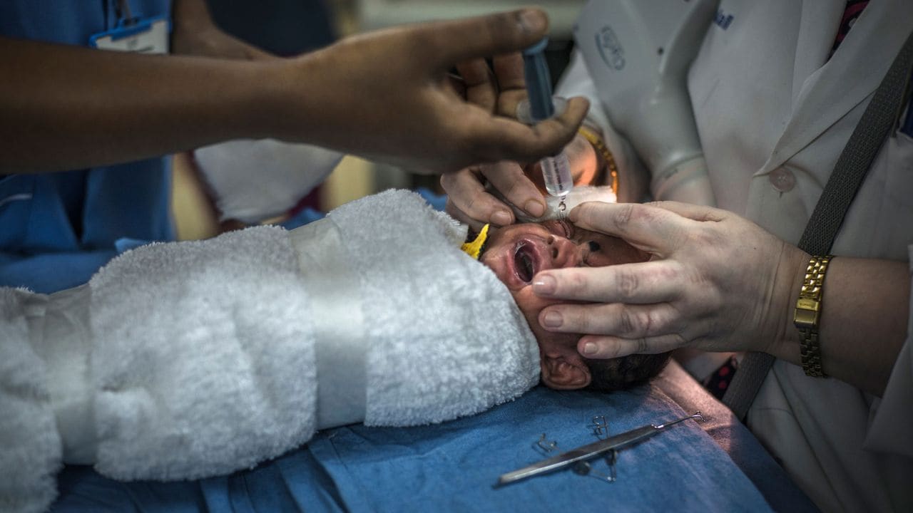A premature baby with retinopathy of prematurity has dilating eye drops applied a few minutes before he receives laser treatment at Hyderabad hospital. Image courtesy: Time To See
