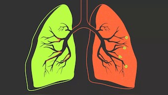 COPD: A threat to life that doesn't discriminate between smokers and non-smokers