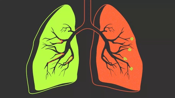 COPD: A threat to life that doesn't discriminate between smokers and non-smokers