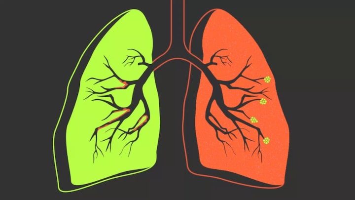 COPD: A threat to life that doesn't discriminate between smokers and non-smokers