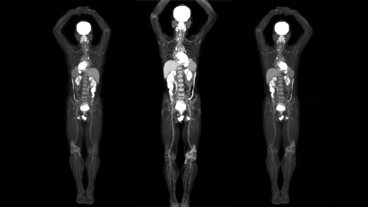 This total body scanner shows 3D images of the whole body