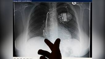 Implant Files: India fares poorly in probe into medical devices industry with low recall rate, non-existent regulations
