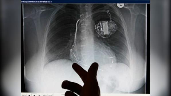 Implant Files: India fares poorly in probe into medical devices industry with low recall rate, non-existent regulations