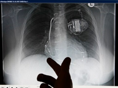 Implant Files: India fares poorly in probe into medical devices industry with low recall rate, non-existent regulations Implant Files: India fares poorly in probe into medical devices industry with low recall rate, non-existent regulations