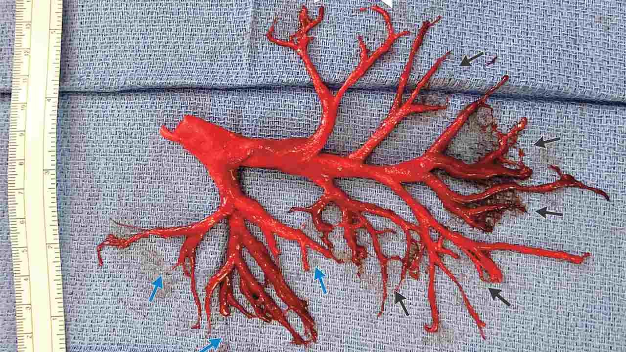 Man coughs up a massive, intact blood clot shaped perfectly like his lung passages Man coughs up a massive, intact blood clot shaped perfectly like his lung passages