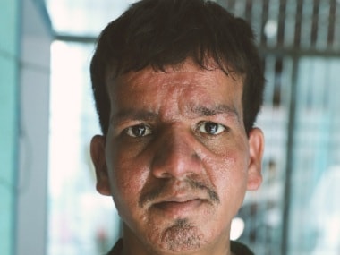 PKDL, the skin manifestation of Kala Azar, could be a major roadblock in the elimination of the disease