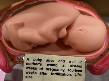 Calcutta High Court rejects woman's plea to abort 26-week-old foetus with Down Syndrome, says 'no harm to mother's life' Calcutta High Court rejects woman's plea to abort 26-week-old foetus with Down Syndrome, says 'no harm to mother's life'