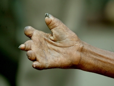 World Leprosy Day: India accounts for over half of 2 lakh cases recorded worldwide; disease curable if diagnosed early World Leprosy Day: India accounts for over half of 2 lakh cases recorded worldwide; disease curable if diagnosed early