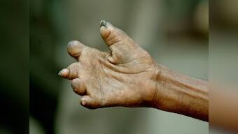 World Leprosy Day: India accounts for over half of 2 lakh cases recorded worldwide; disease curable if diagnosed early