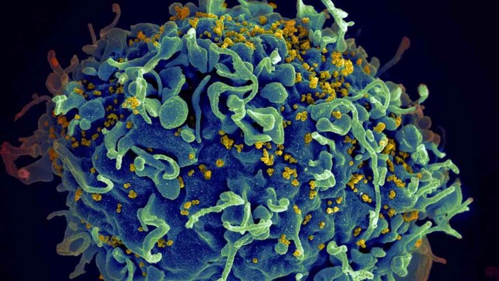 Woman cured of HIV infection without medical treatment, risky bone marrow transplant
