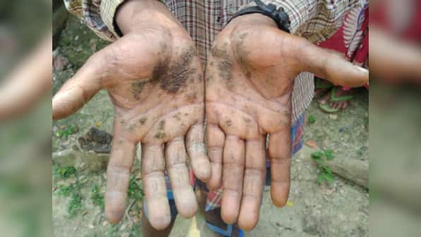 Silent killer arsenic slowly poisoning crores of people in West Bengal as successive govts fail to address issue
