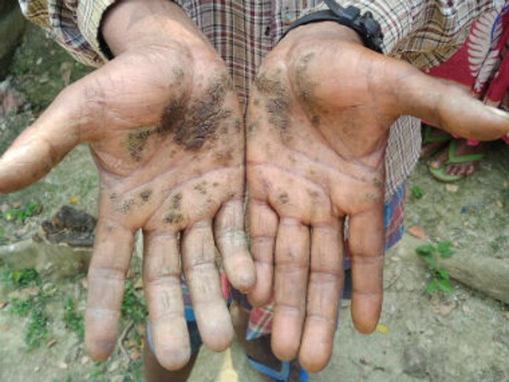 Silent killer arsenic slowly poisoning crores of people in West Bengal as successive govts fail to address issue