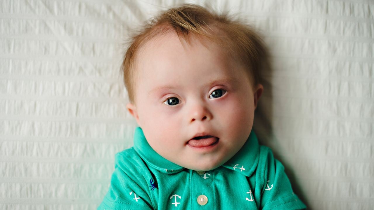 An infant with Down syndrome. Image courtesy: Waterloo Regional Down Syndrome Society WRDSS