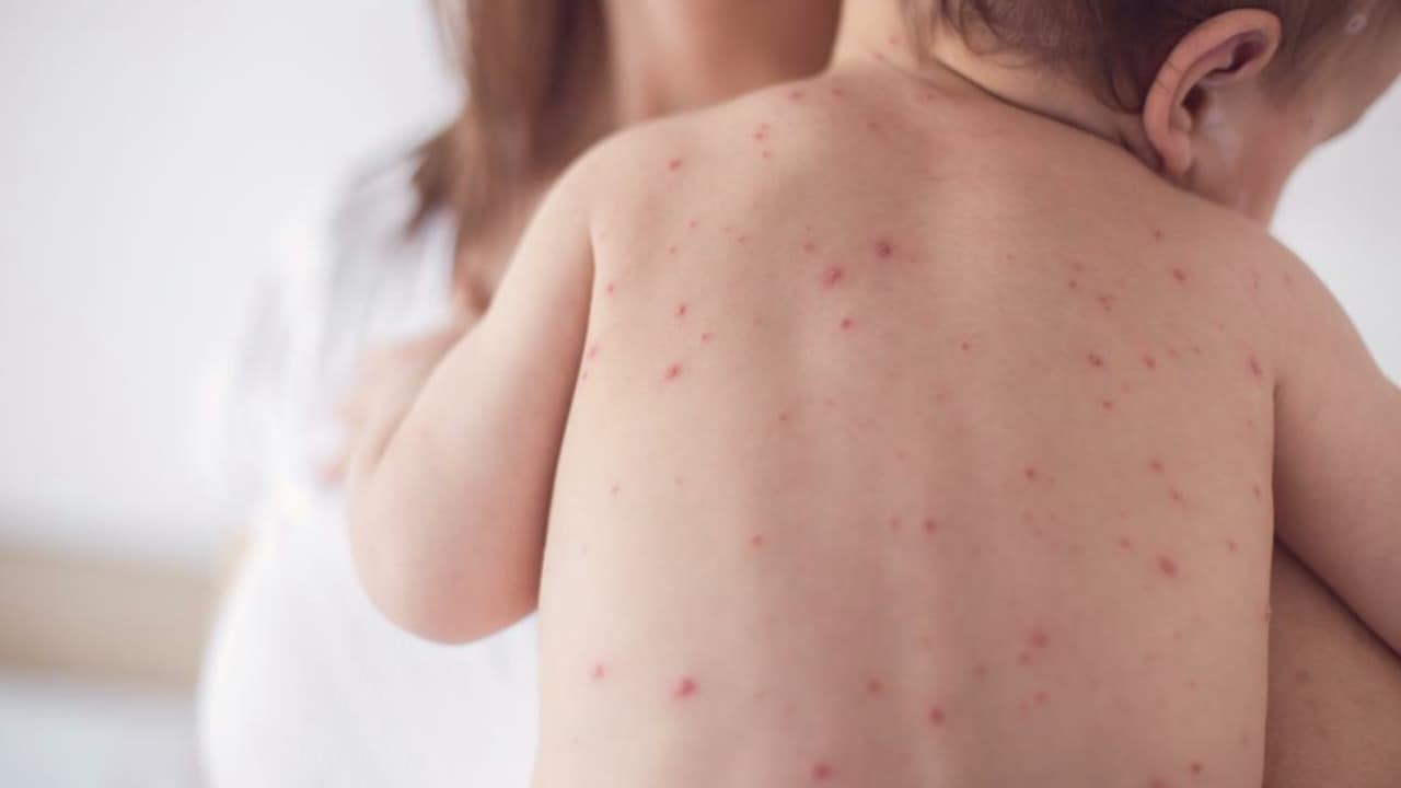 Measles spots on an unwitting baby.