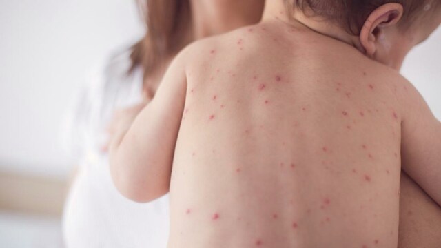 کودکان در سراسر جهان واکسن سرخک را به دلیل COVID-19 از دست نداده اند و می تواند باعث شیوع آن شود