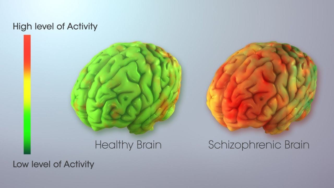 How a healthy and schizoprenic differ in brain activity. Image credit: scientificanimations com