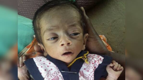 Congress in Madhya Pradesh adopts erstwhile BJP govt's inaction, fails to tackle malnutrition plaguing several districts