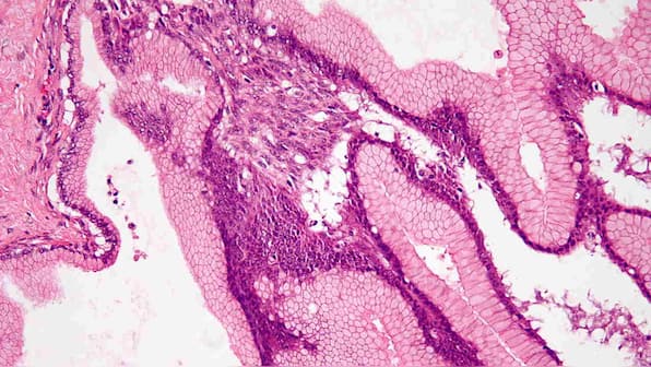 Gene-therapy pill slows pancreatic cancer, extends survival by two years in trials