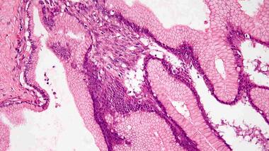 Gene-therapy pill slows pancreatic cancer, extends survival by two years in trials