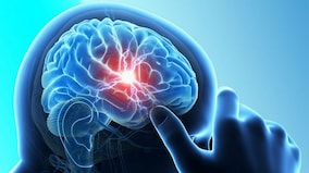 Women more likely to die within a year of experiencing their first stroke compared to men, finds study