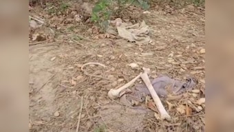 Bihar: Human skeletons found lying near Muzaffarpur's SKMCH hospital, where 108 people died of Encephalitis