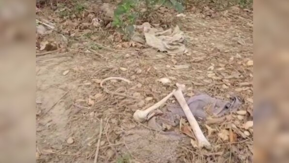 Bihar: Human skeletons found lying near Muzaffarpur's SKMCH hospital, where 108 people died of Encephalitis