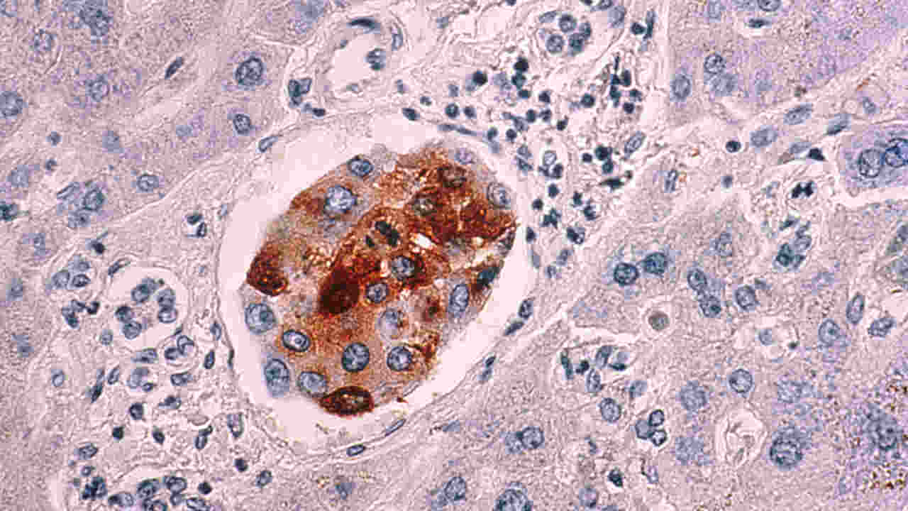 Radio-wave therapy targeted liver cancer cells without damaging the healthy ones Radio-wave therapy targeted liver cancer cells without damaging the healthy ones