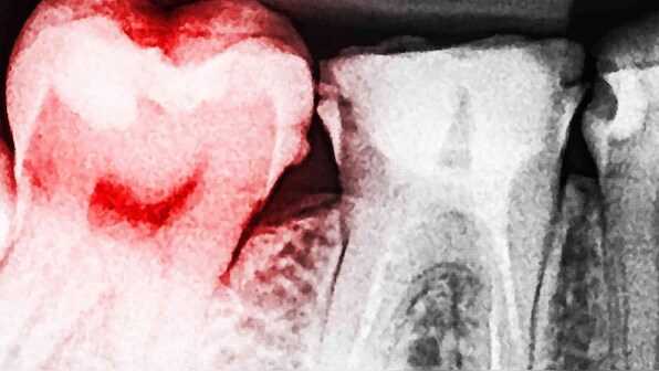 Genes, obesity and hereditary traits play a role in tooth decay, gum disease: Study