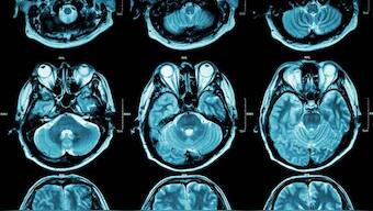Specific genes influence depression to an extent of PTSD, bipolar disorder, schizophrenia: Study