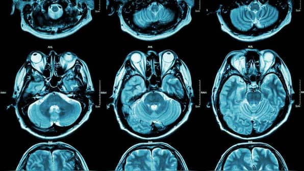 Specific genes influence depression to an extent of PTSD, bipolar disorder, schizophrenia: Study