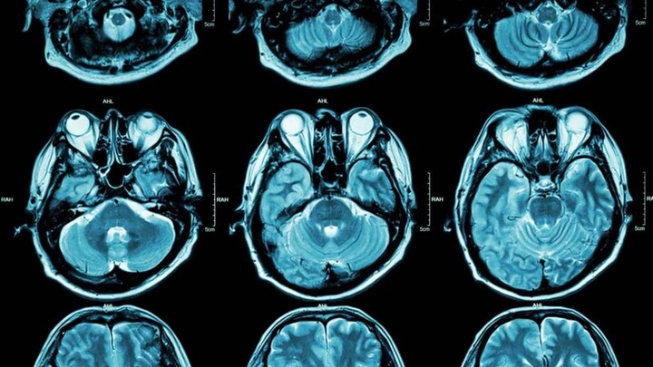 Specific genes influence depression to an extent of PTSD, bipolar disorder, schizophrenia: Study