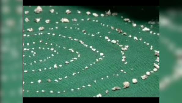 Doctors extract 526 teeth from 7-year-old boy's lower jaw in Tamil Nadu; surgeons claim it's first such case in the world