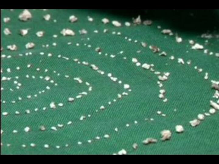 Doctors extract 526 teeth from 7-year-old boy's lower jaw in Tamil Nadu; surgeons claim it's first such case in the world