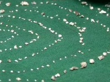 In jaw-dropping operation, 526 teeth of different sizes extracted from seven-year-old's mouth in Chennai In jaw-dropping operation, 526 teeth of different sizes extracted from seven-year-old's mouth in Chennai