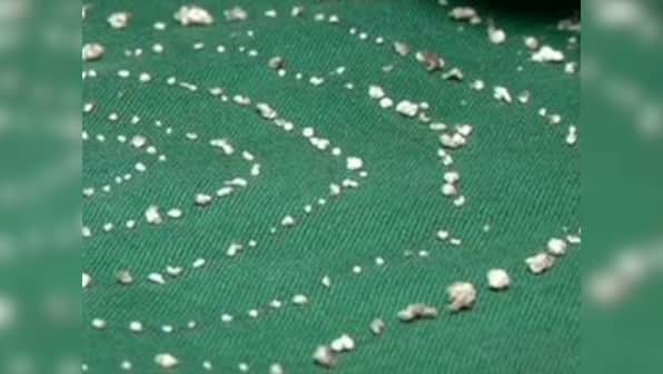 In jaw-dropping operation, 526 teeth of different sizes extracted from seven-year-old's mouth in Chennai