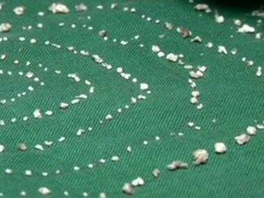 In jaw-dropping operation, 526 teeth of different sizes extracted from seven-year-old's mouth in Chennai