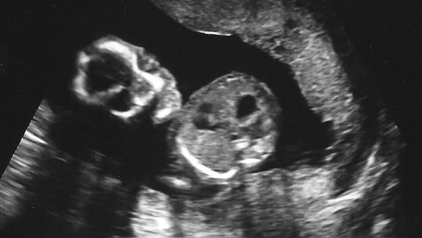 Black carbon particles, from air pollution, are being found in the placenta