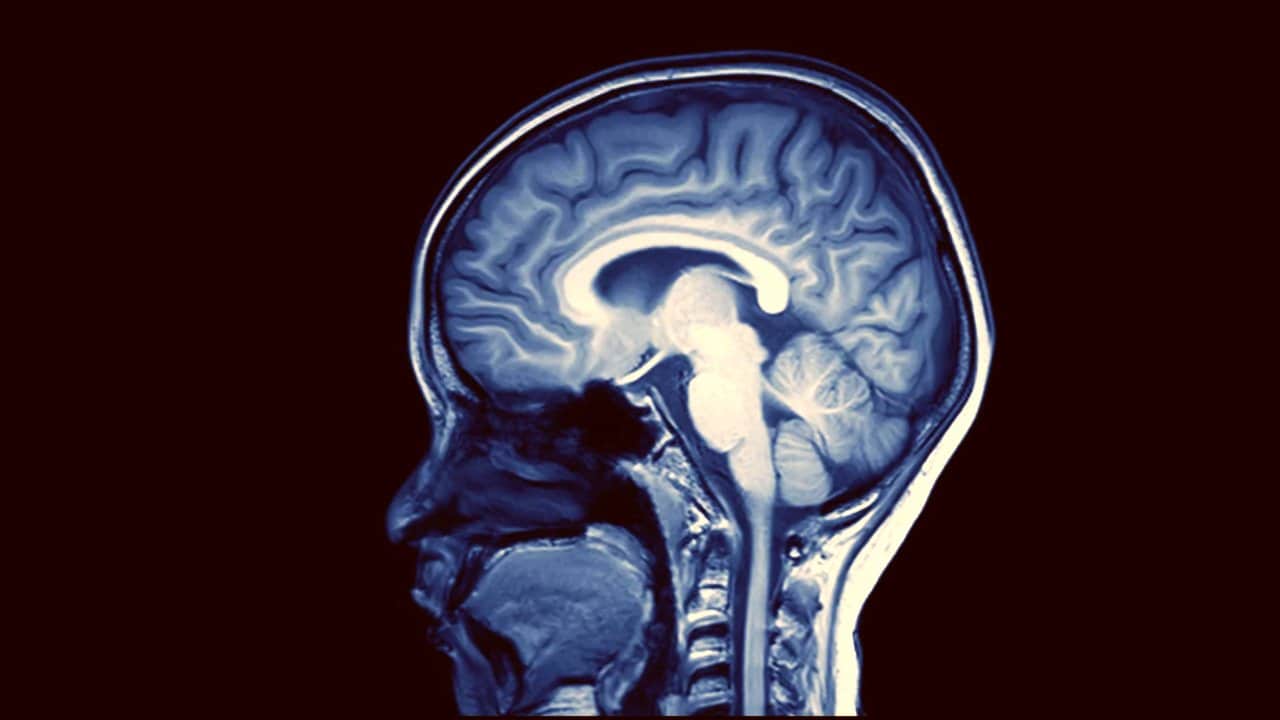 Brain scan showing signs of dementia. Alzheimers