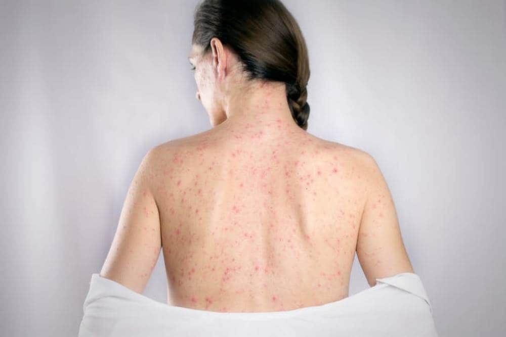 Rubella is a viral illness that causes a mild fever and a skin rash. image credit: OneSideProFoto/Shutterstock