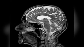 Cerebral aneurysm: What happens when the brain bleeds